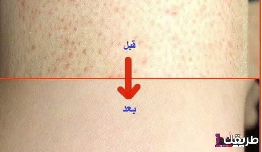 تجربتي في علاج جلد الوزة وأسباب الإصابة بها 2 225 20210614194436